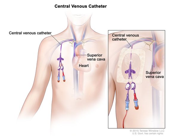Lines, Leads, Tubes and Drains…Oh My! – OT Caroline